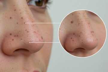 Puntos negros: elimínalos y prevenlos así | Priti Beauty Care